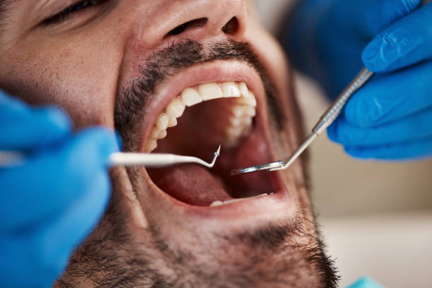 Best Emergency Dental Care for Broken or Chipped Teeth in Nashville, TN